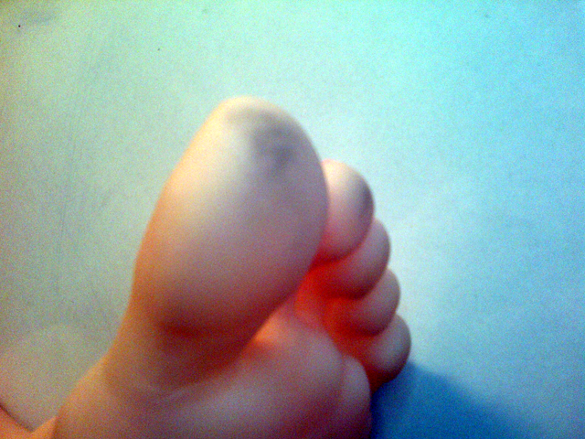 Chelsea's stained big toe