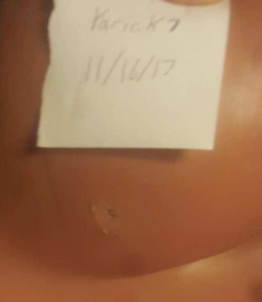 Mark on side of right breast